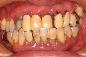 歯周病（P3）２－１(050102020)